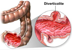 Diverticoli del colon