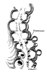 Diverticoli del colon